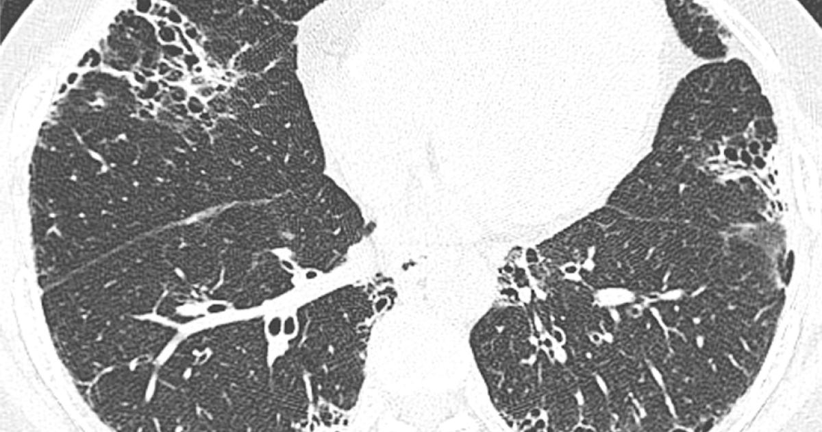 These CT findings increase risk of thromboembolic events for patients with COVID pneumonia